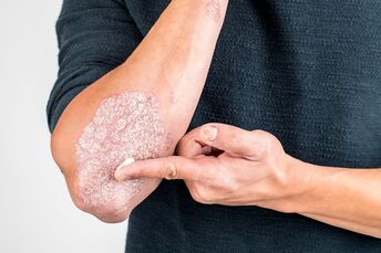 Apply the cream to the affected areas of the psoriasis