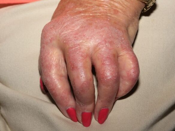 Manifestations of psoriasis on hands