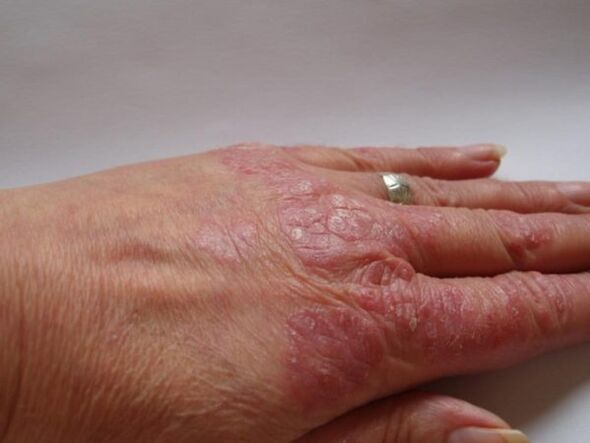 Psoriasis patches on hands