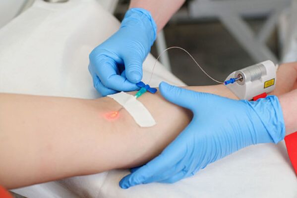 Intravenous laser treatment for psoriasis of the legs