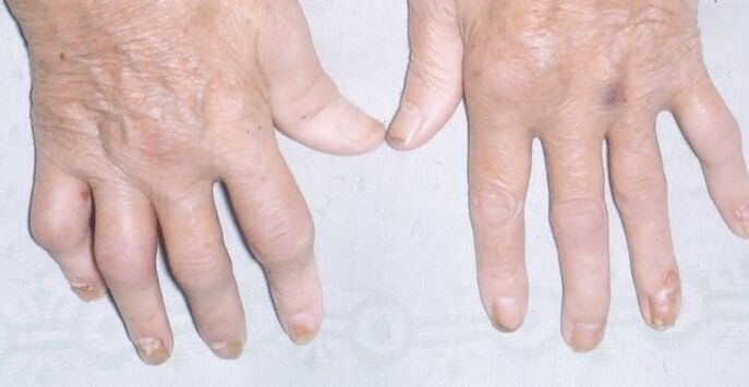 psoriasis joints on hands