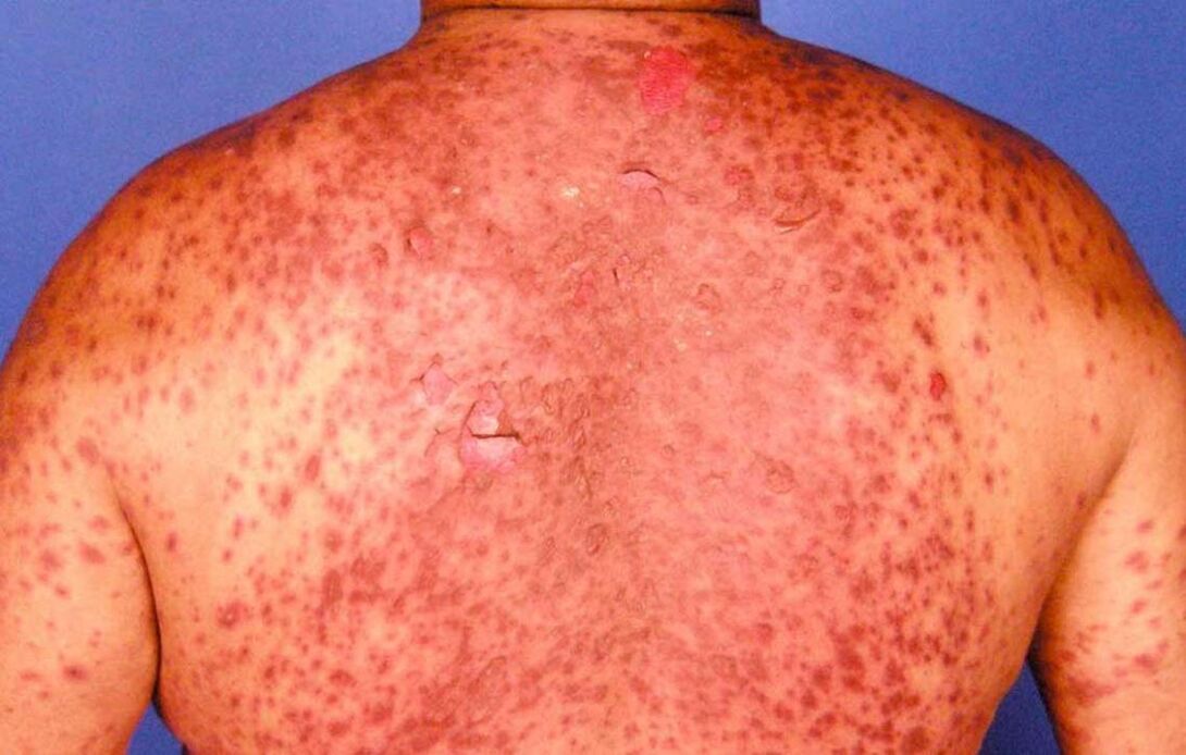 psoriatic erythema of the back