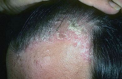 psoriasis on top of photo 1