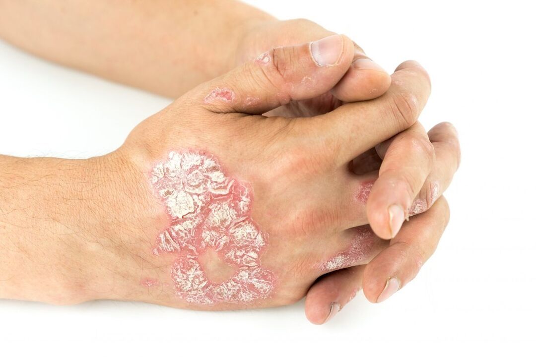 What does psoriasis on hands look like 
