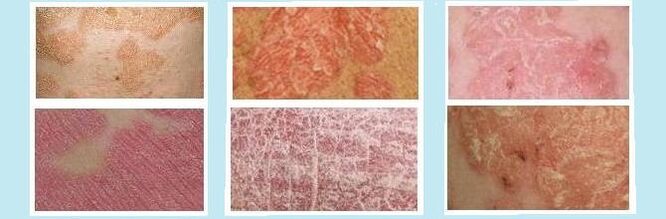 Skin rashes characteristic of different types of psoriasis