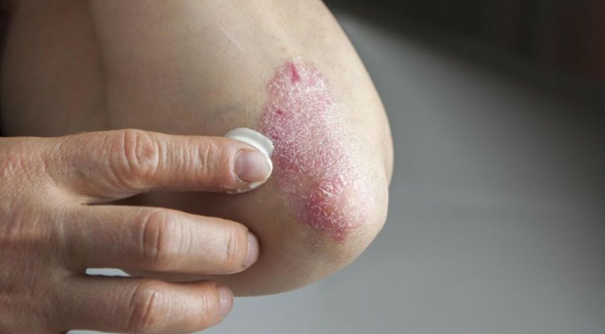 Psoriasis affects the skin, treatment includes the use of ointments