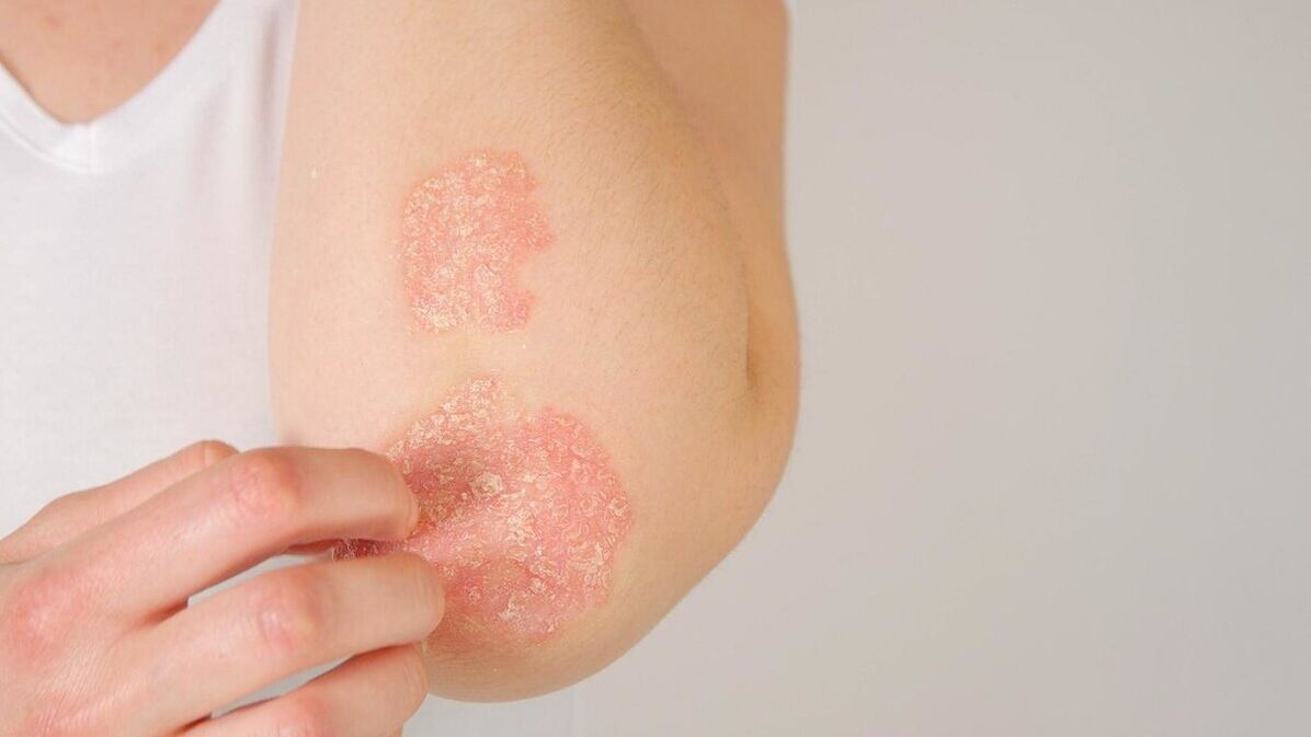 Psoriatic plaques on the elbow