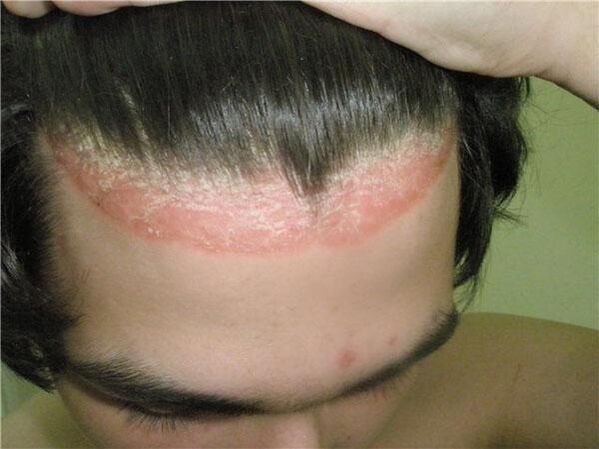 Symptoms of scalp psoriasis