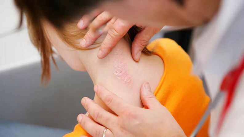 psoriatic scales and plaques on the back of the neck