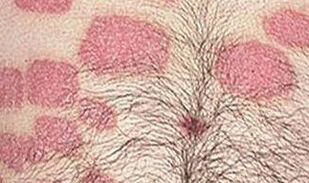 Many pink forms on the abdomen