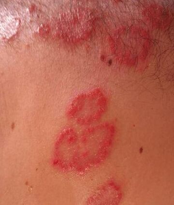 Psoriasis