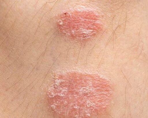 The appearance of psoriasis