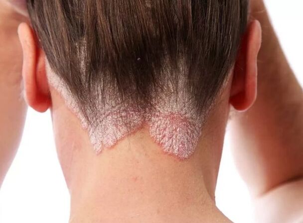 Erythroderma psoriasis