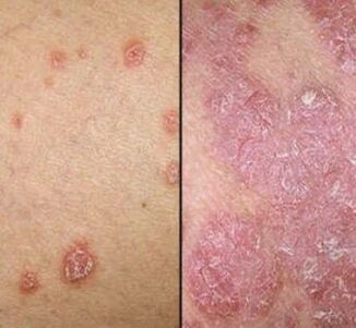 Psoriasis
