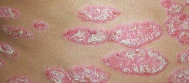 The progression of psoriasis