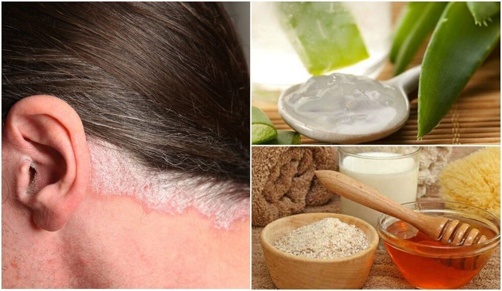 Treatment of psoriasis by folk methods