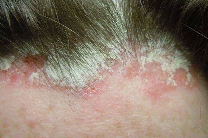 Psoriasis captures the entire hair of the head