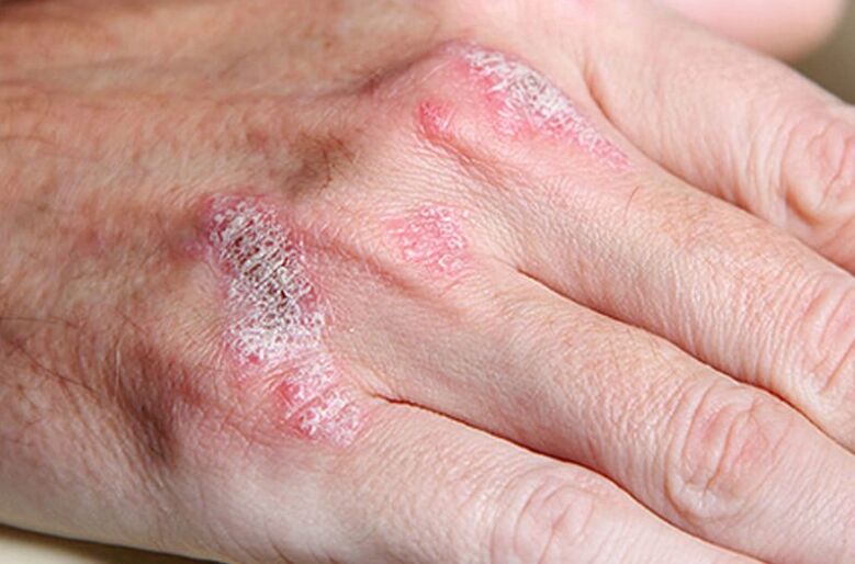 Psoriasis maintains Ladomary