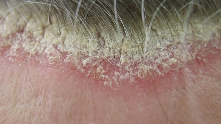 Psoriasis of scalp
