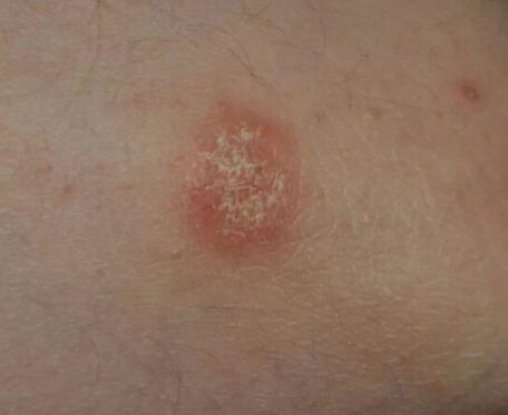 Psoriasis