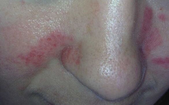 Symptoms of psoriasis on the face