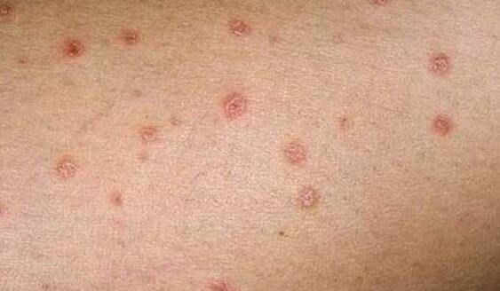 Initial stage of psoriasis
