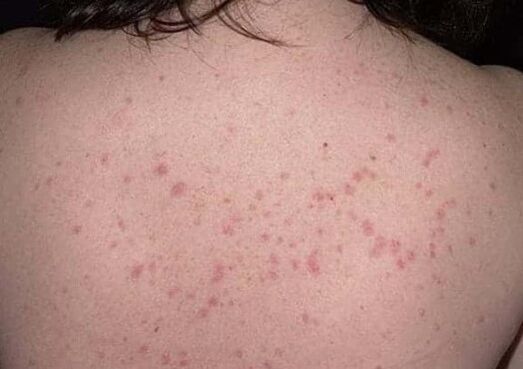 Initial stage of psoriasis