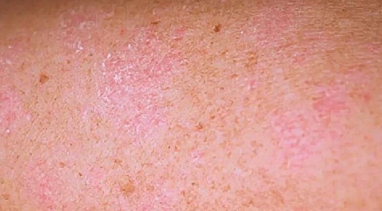 Psoriasis period