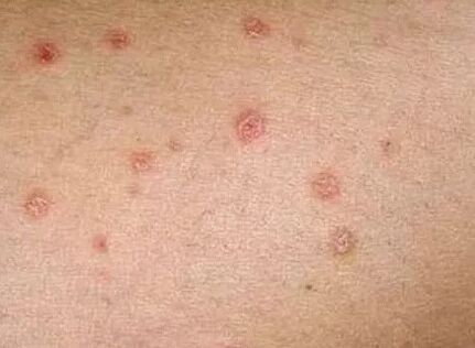 Psoriasis of the initial stage