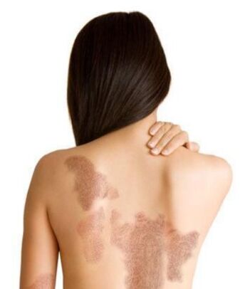 The stages of psoriasis depend on the area of ​​the lesion