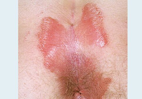 Psoriasis