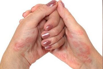 Psoriasis in hand