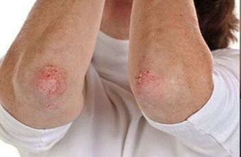 Psoriasis on the elbow