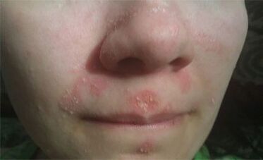 Psoriasis on the face