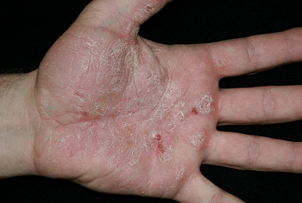 Psoriasis in hand