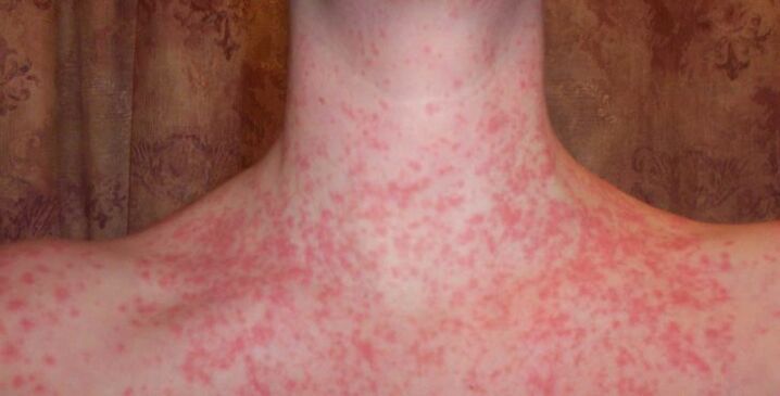 Psoriasis on the body