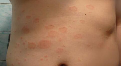 Psoriasis of the initial stage
