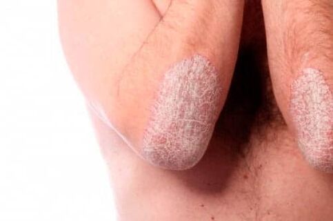 Psoriasis of the elbow