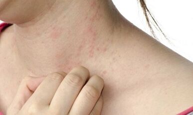 Treatment of psoriasis in late stages