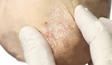 Treatment of psoriasis in the waning stage