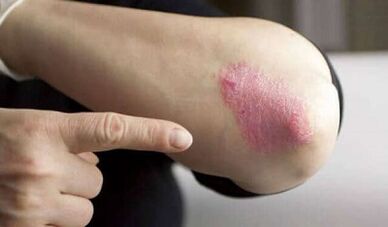 stable phase of psoriasis development