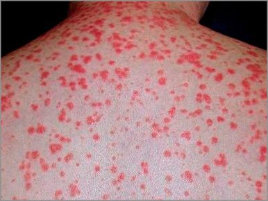 Guttate psoriasis