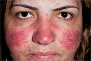 Seborrheic psoriasis