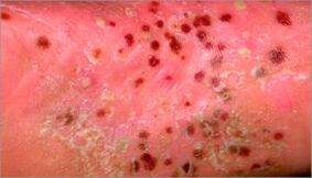 pustular psoriasis