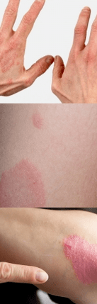 Psoriasis of the first stage in hand
