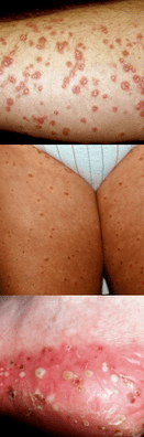 Psoriasis on legs