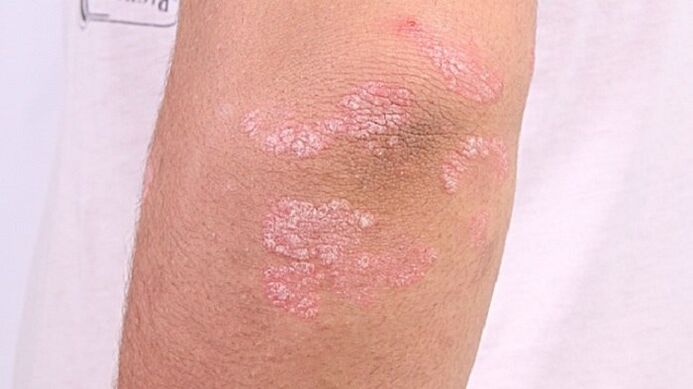 Images of early stage psoriasis