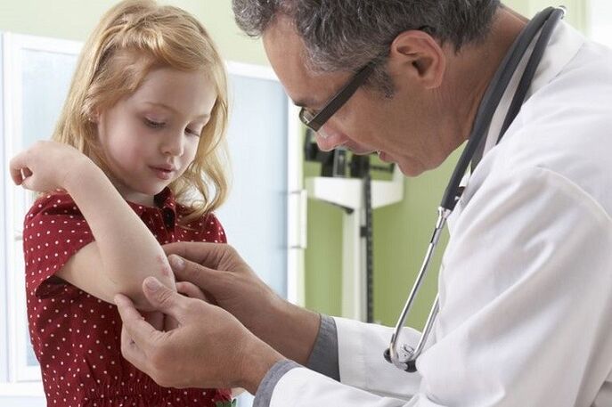 Psoriasis at an early age