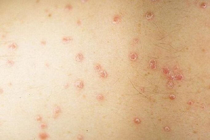 Symptoms of topical psoriasis