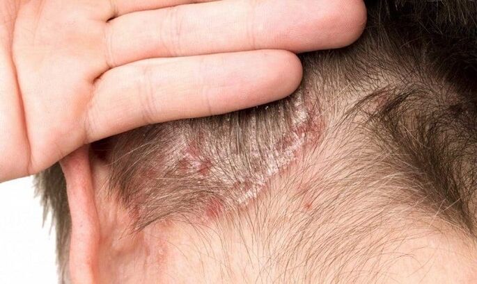 psoriasis on the head